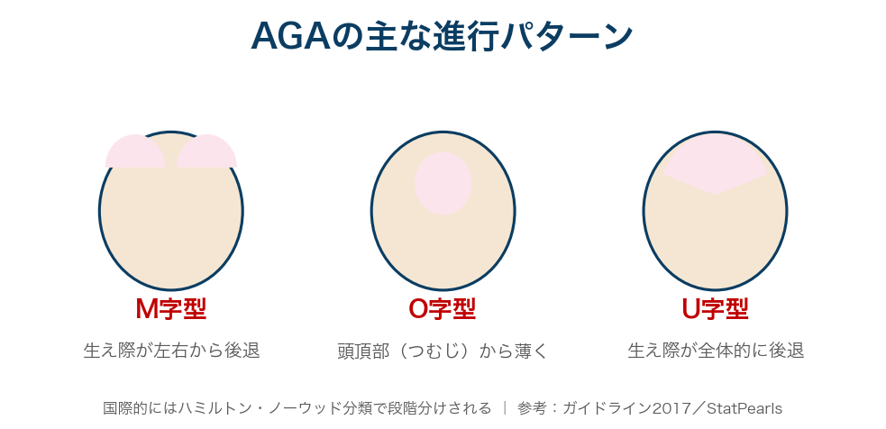 M字型・O字型から進みU字型へ。M字は生え際の後退