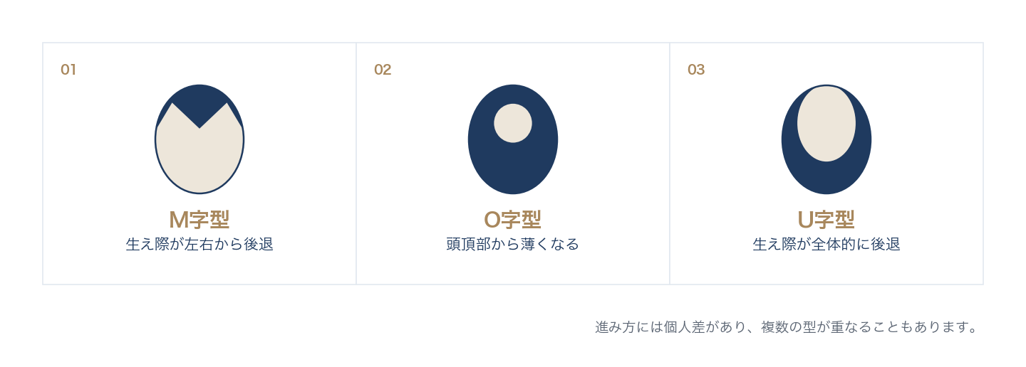 AGAはM字型・O字型から進みU字型につながる