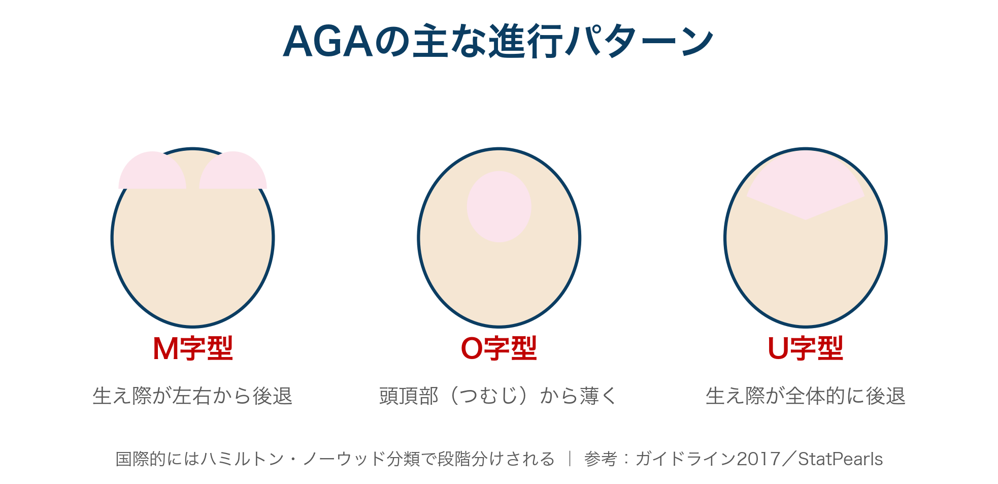 AGAの進行パターンとハミルトン・ノーウッド分類