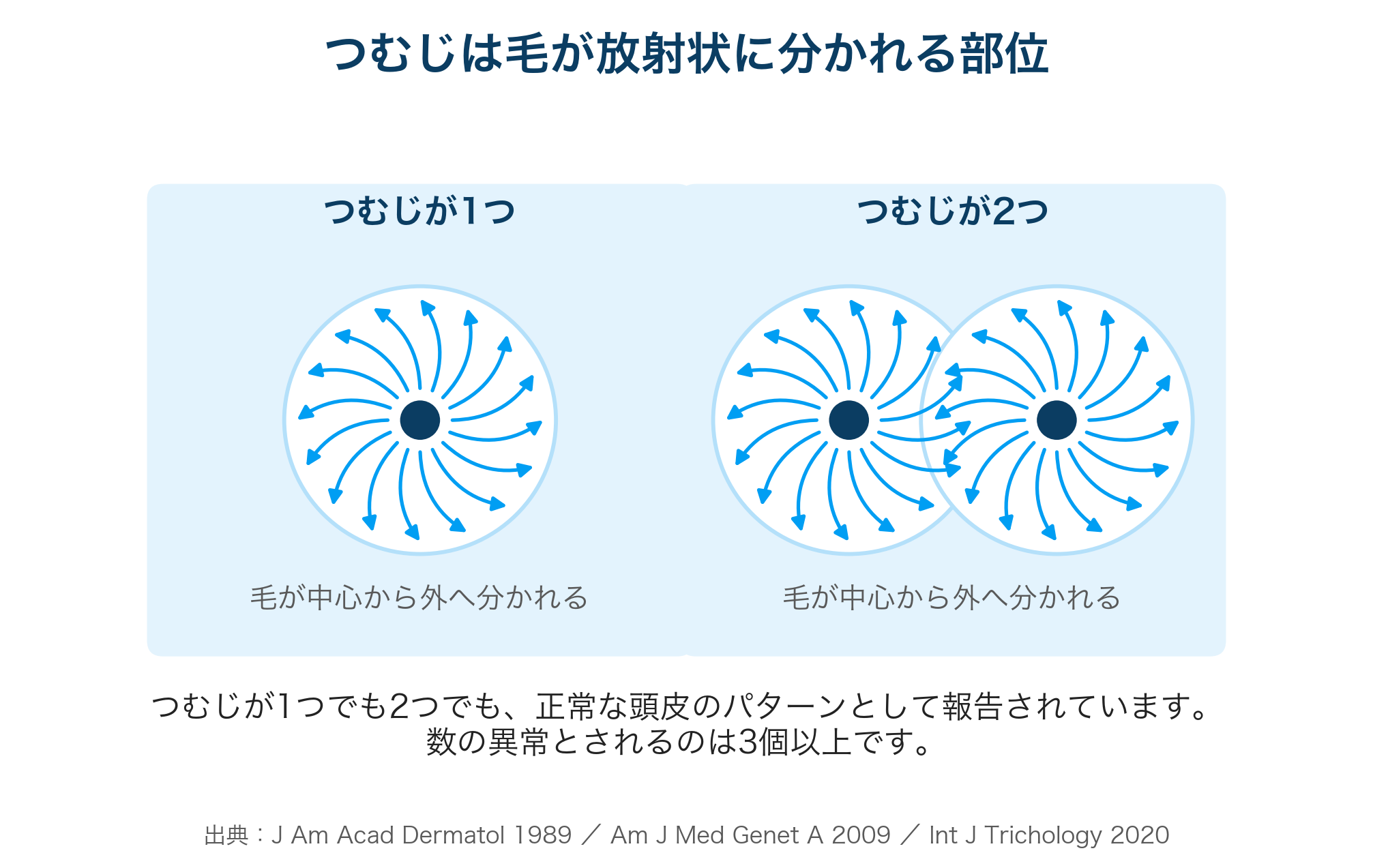 つむじが1つの場合と2つの場合の毛流を示した模式図（どちらも正常）